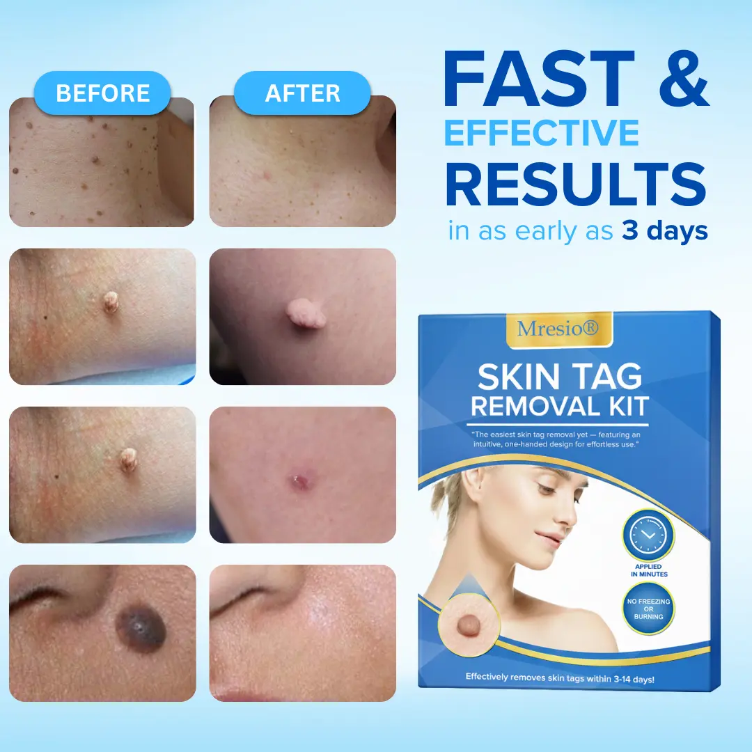 Skin Tag Removal Kit - Image 3