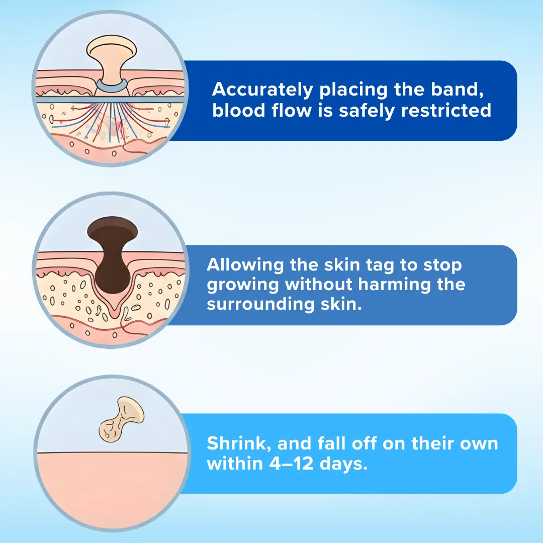 Skin Tag Removal Kit - Image 5