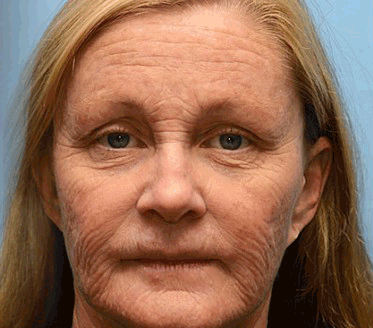 Botox Bee Venom Wrinkle Removal Cream - Image 8