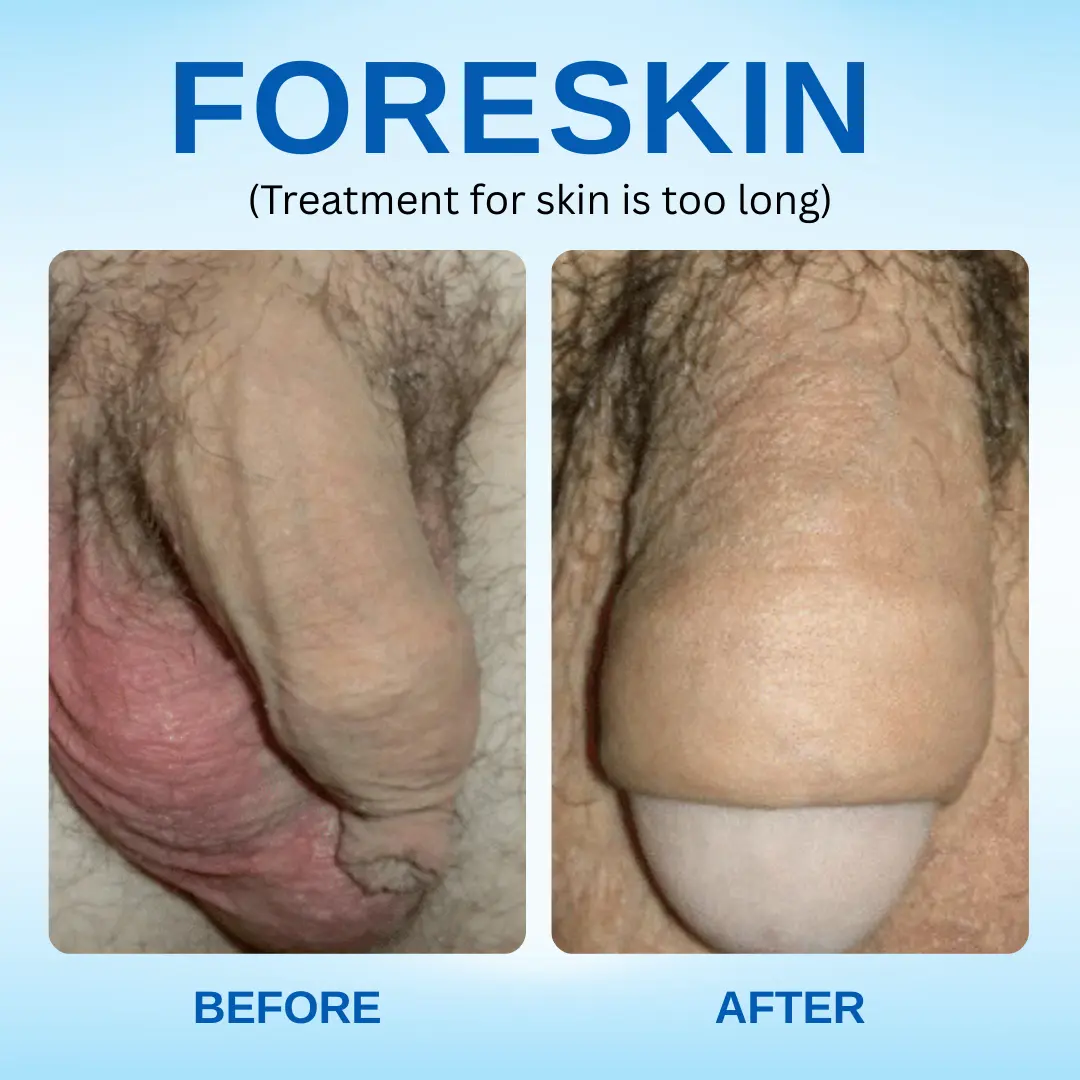 Redundant Prepuce Corrector Gel - Image 5