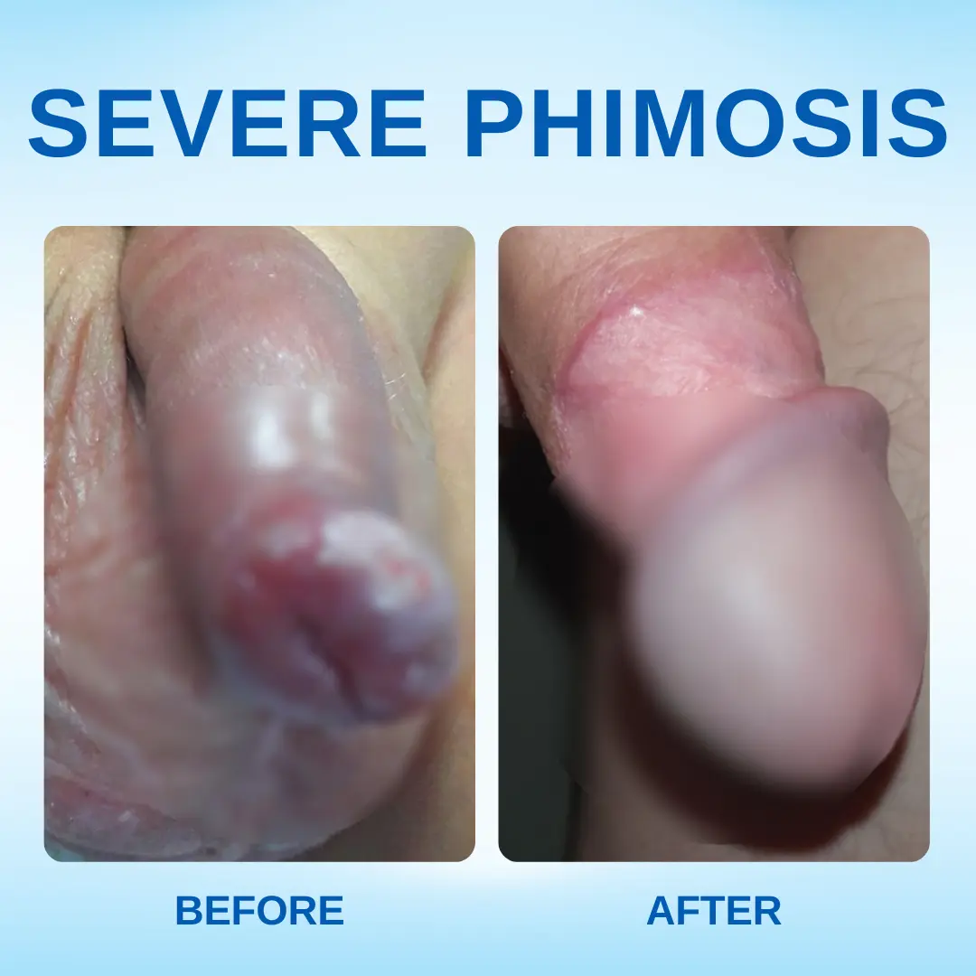 Redundant Prepuce Corrector Gel - Image 6