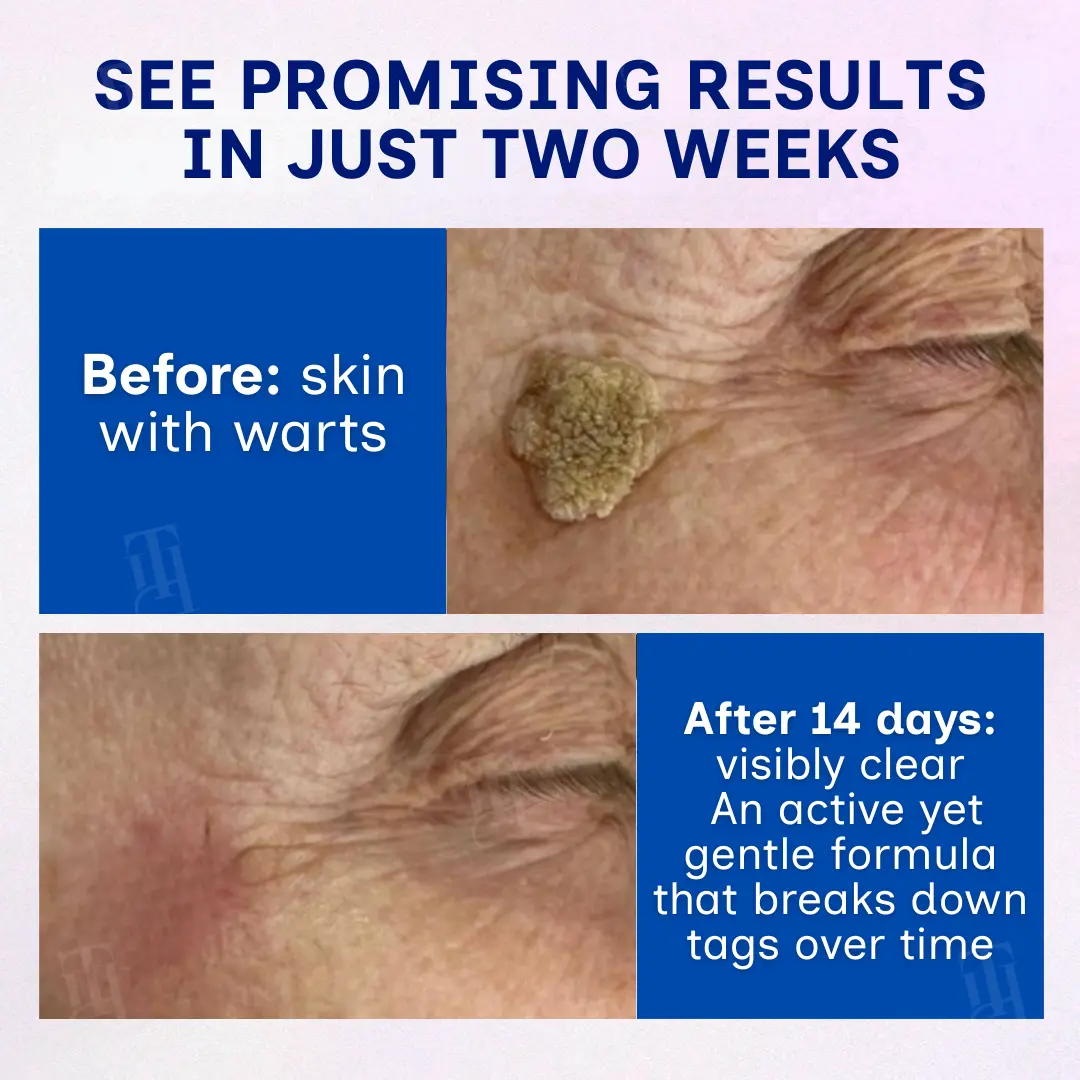 Solid-Stick Wart Remover, Skin Tags in Just 48 Hours - Image 2