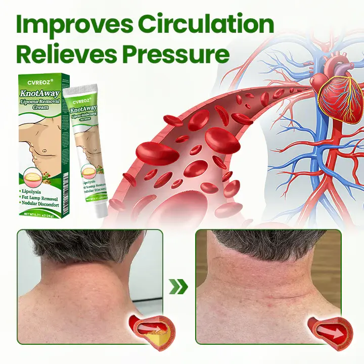 KnotAway Lipoma Removal Cream - Image 5