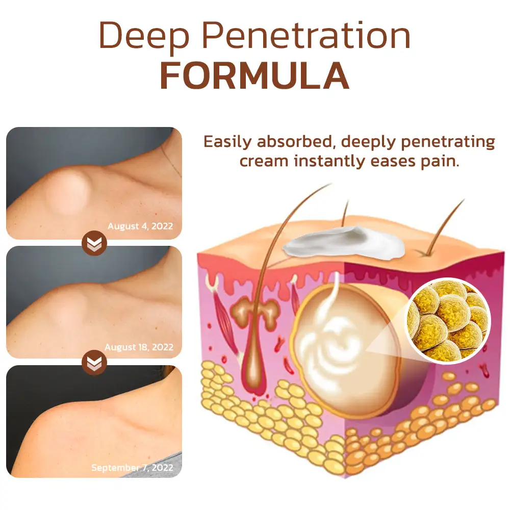 Lumpless Lipoma Treatment Cream - Image 2
