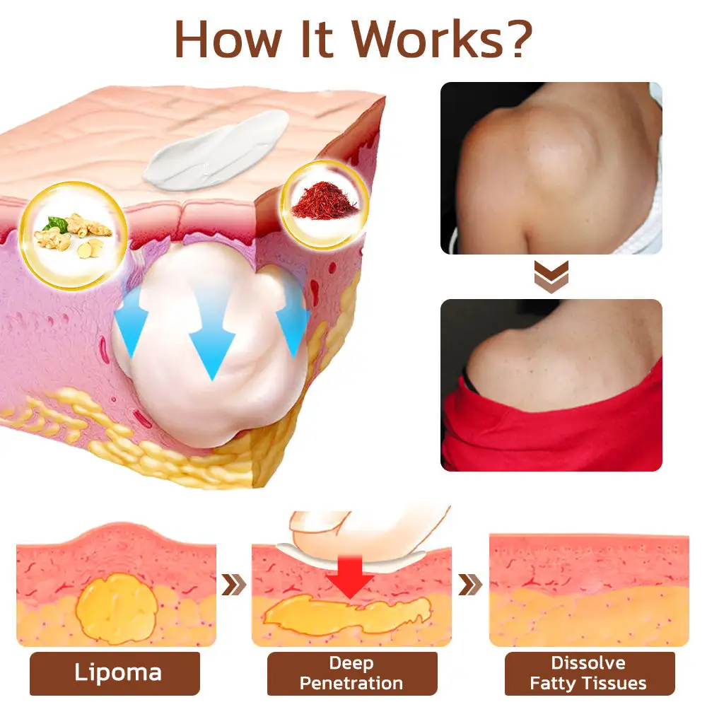 Lumpless Lipoma Treatment Cream - Image 3