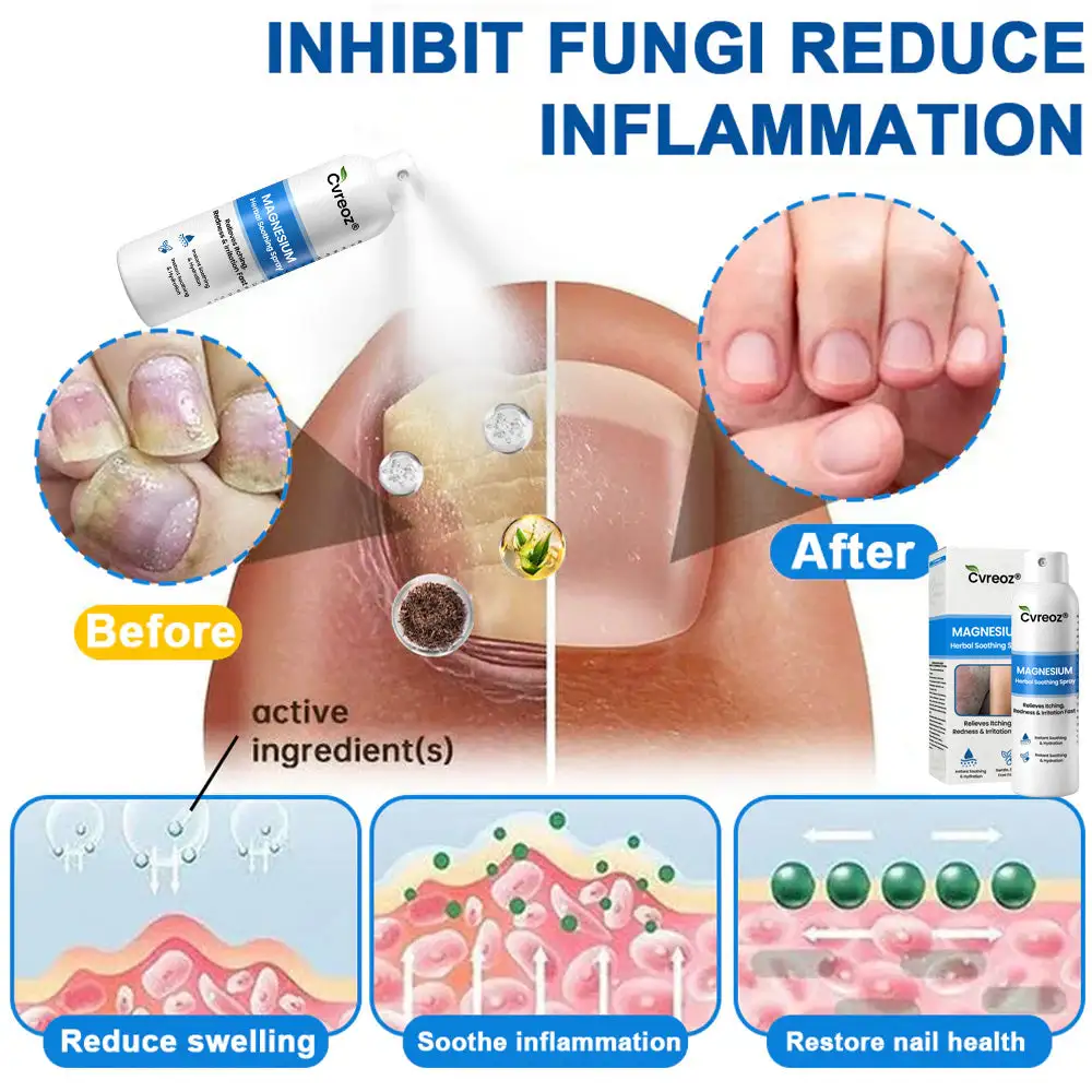 Magnesium Herbal Psoriasis Spray - Image 2