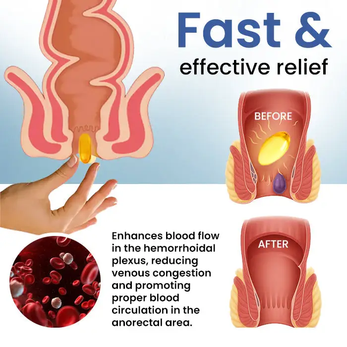 Natural Hemorrhoid Capsules - Image 3