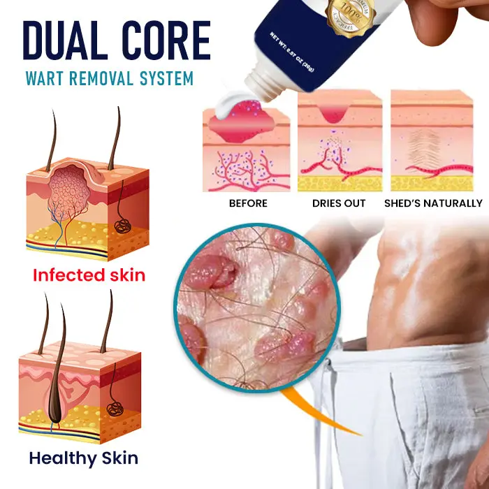 Genital Warts Remover Cream - Image 3