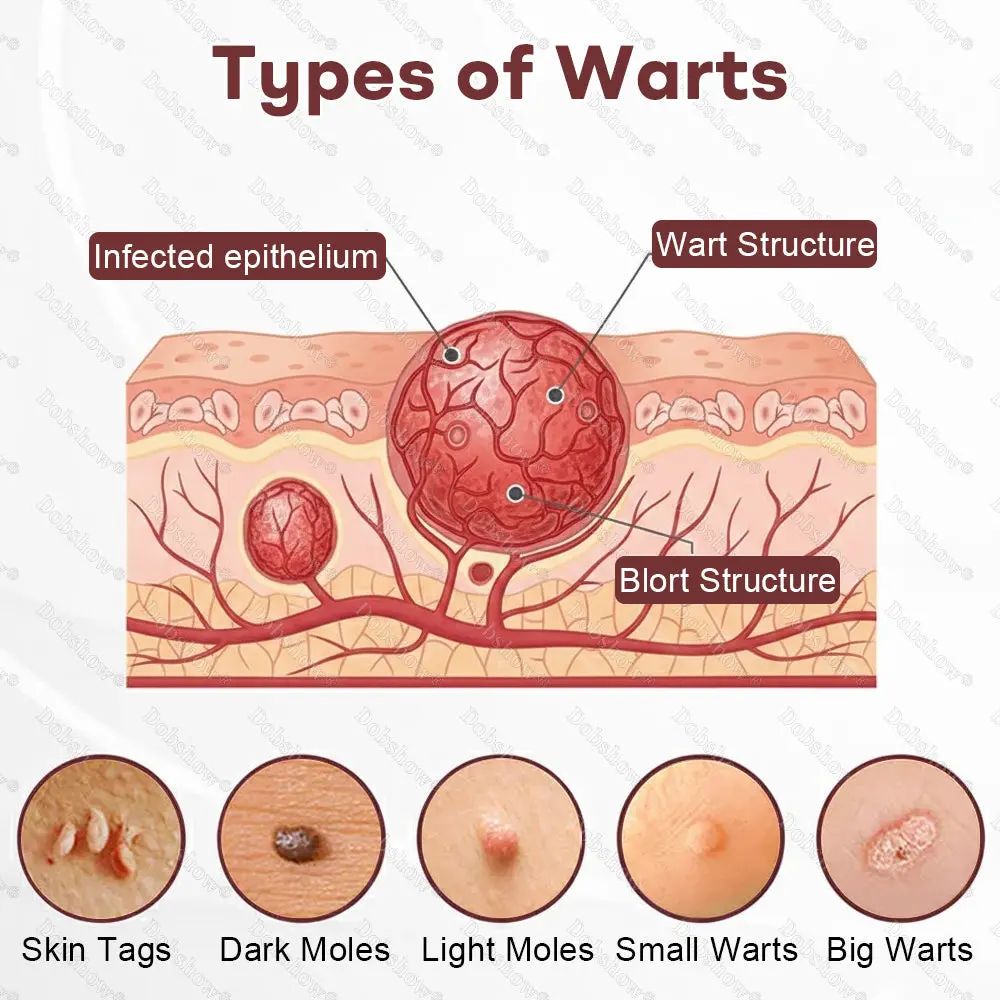 BlackRice Wart Recovery Cream Suitable for all skin types - Image 3