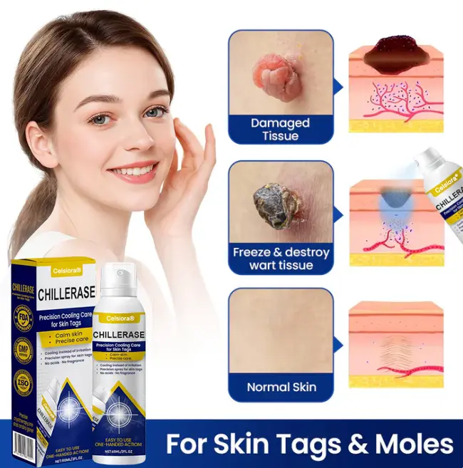 ChillErase Cooling Spray for Skin Tags - Image 2