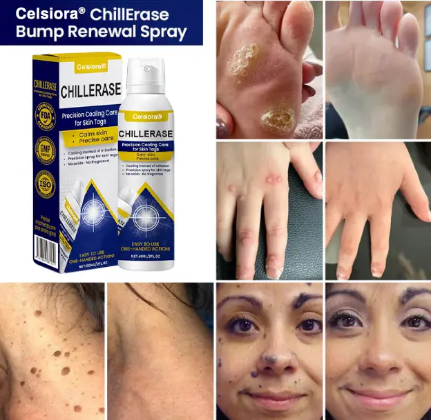 ChillErase Cooling Spray for Skin Tags - Image 3