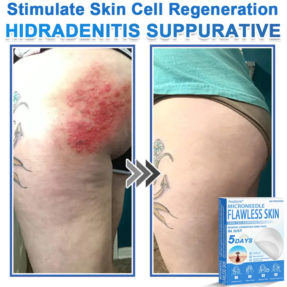 2-in-1 Microneedle & Hydrocolloid Patch - Image 11