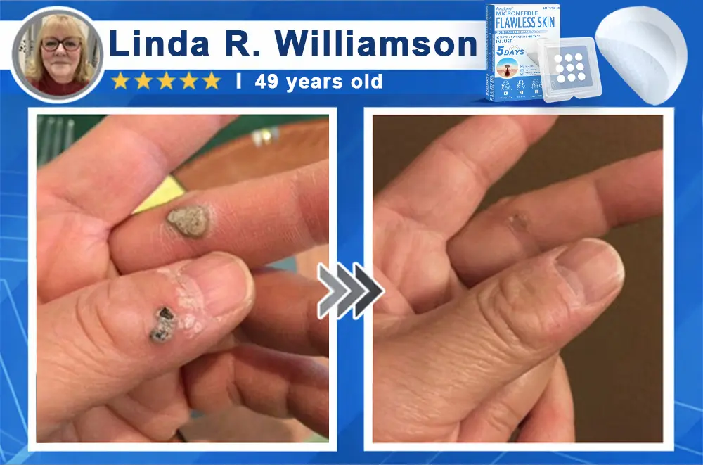 2-in-1 Microneedle & Hydrocolloid Patch - Image 13