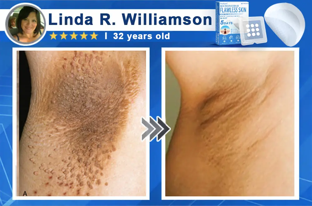2-in-1 Microneedle & Hydrocolloid Patch - Image 15