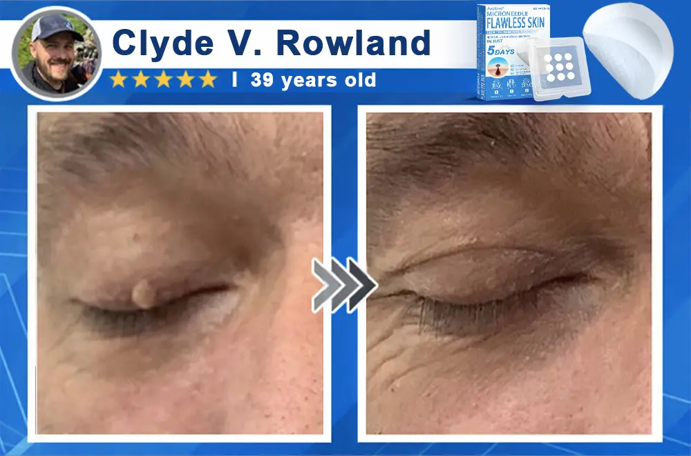 2-in-1 Microneedle & Hydrocolloid Patch - Image 6