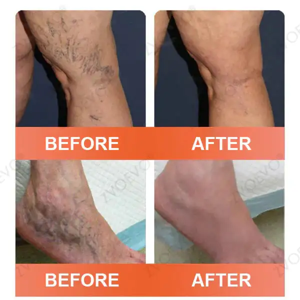 Vein Ease Microneedle Care Patch - Image 4