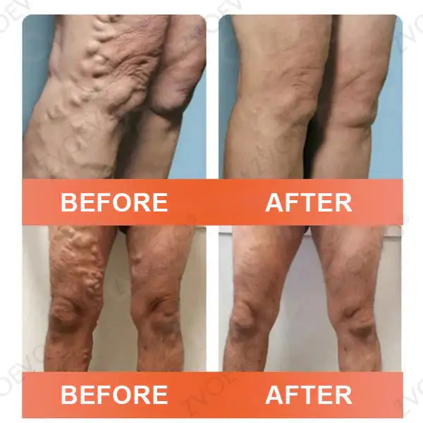 Vein Ease Microneedle Care Patch - Image 5