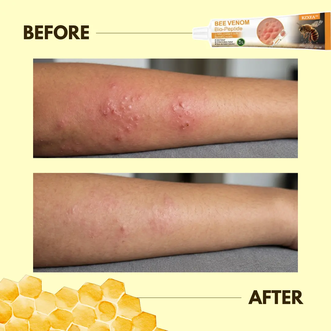Bee Venom Bio-Peptide 2-Min Instant Itch Relief Cream - Image 4