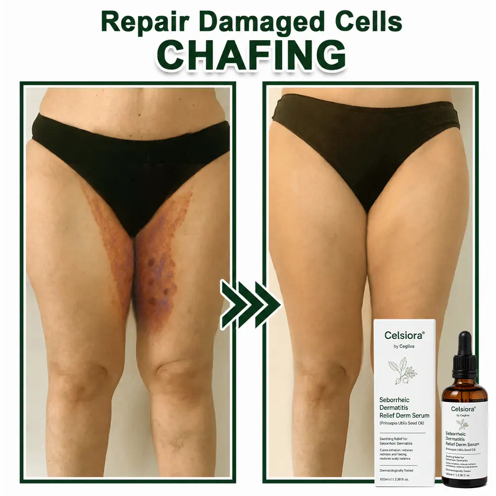 Seborrheic Dermatitis Relief Derm Serum - Image 10