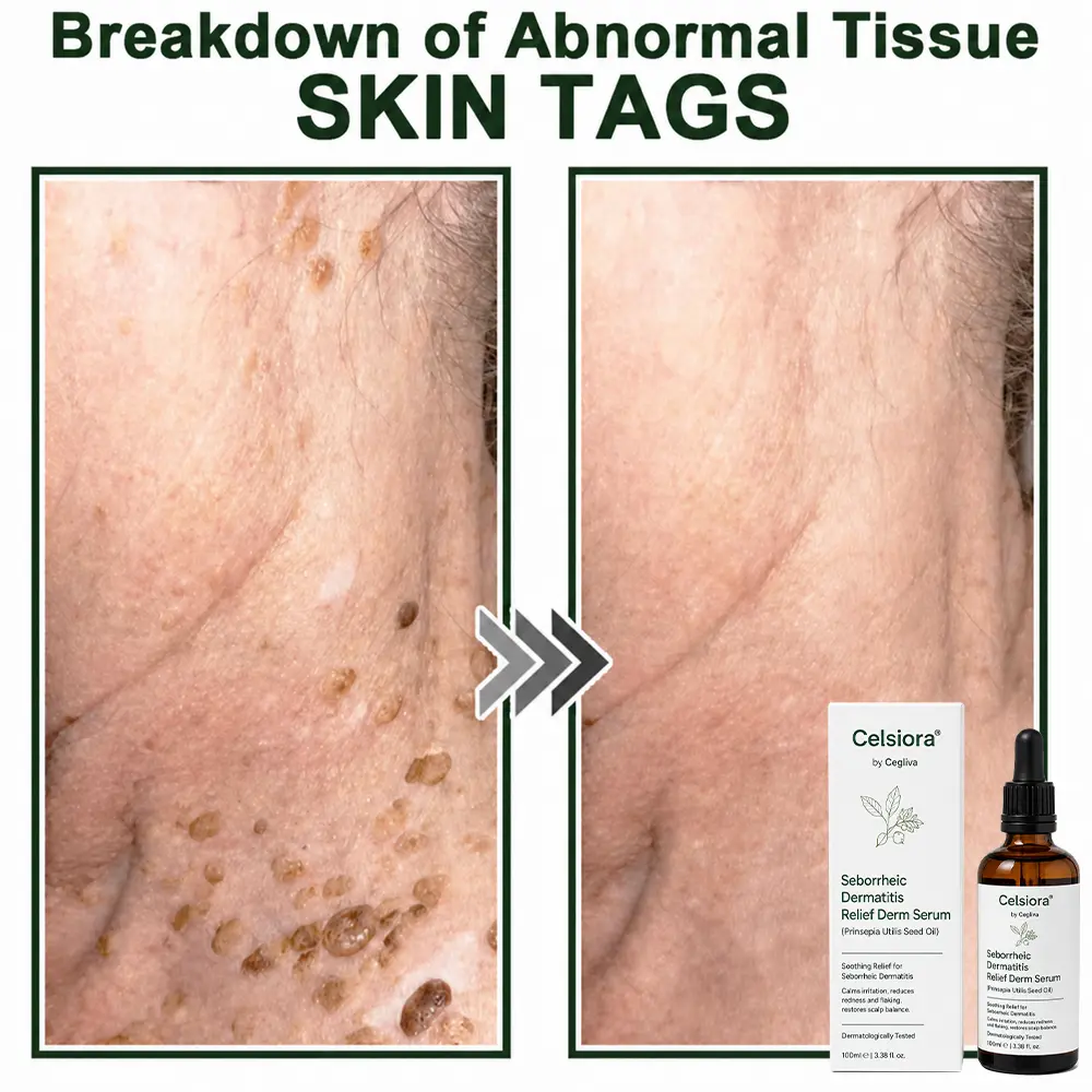 Seborrheic Dermatitis Relief Derm Serum - Image 12