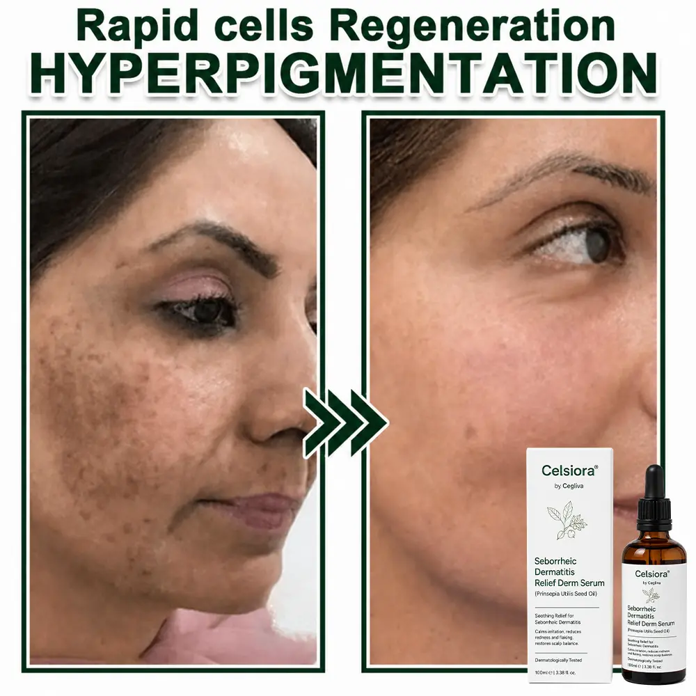 Seborrheic Dermatitis Relief Derm Serum - Image 13