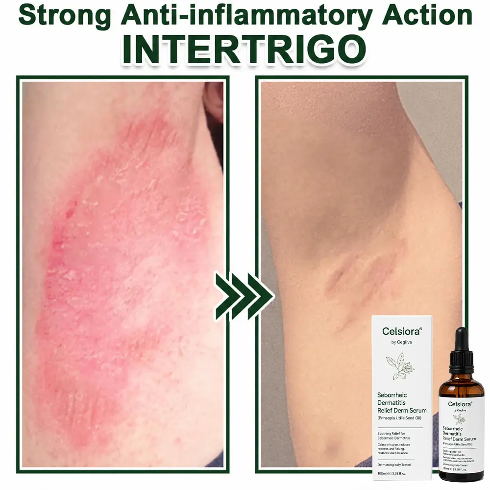 Seborrheic Dermatitis Relief Derm Serum - Image 14