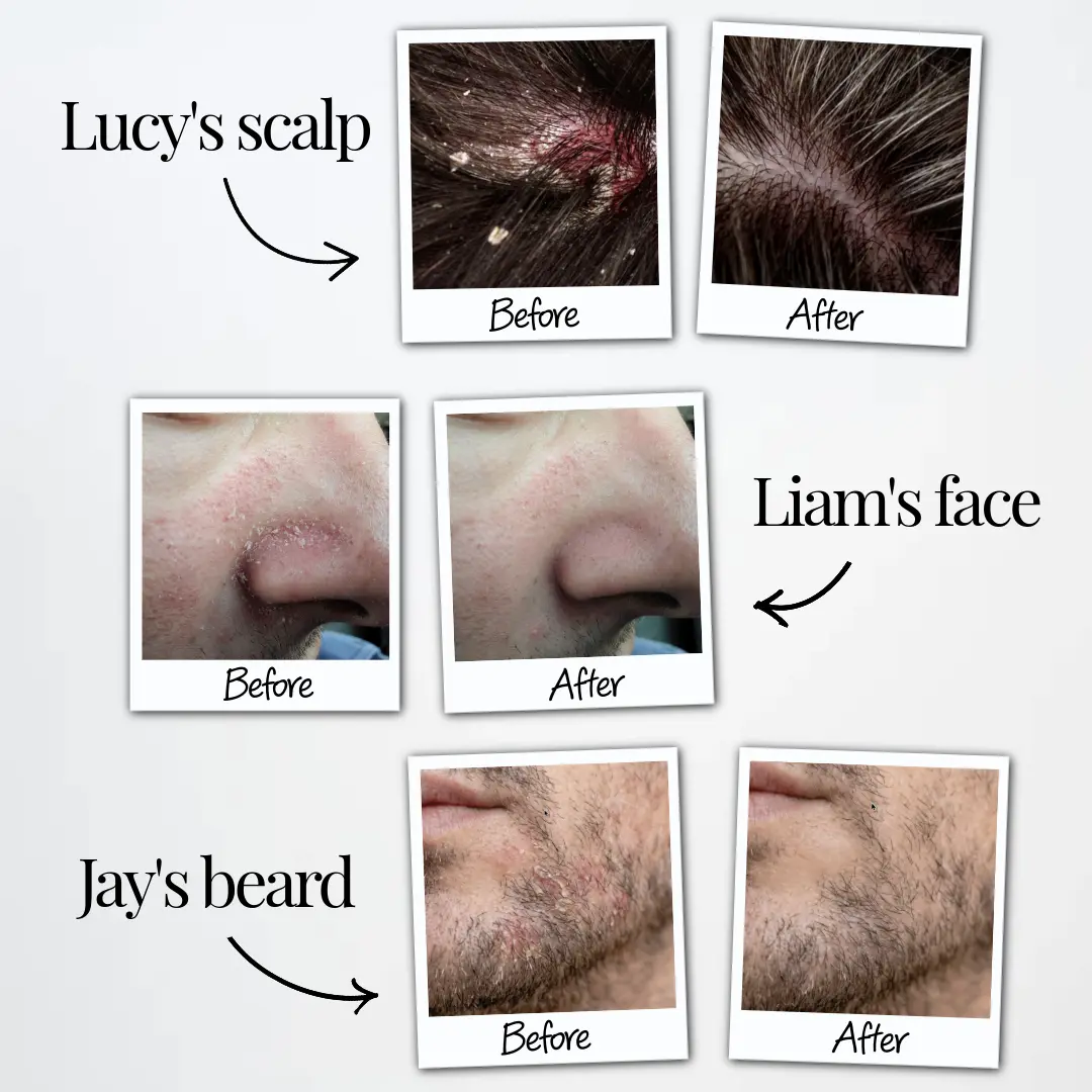 Seborrheic Dermatitis Relief Derm Serum - Image 7