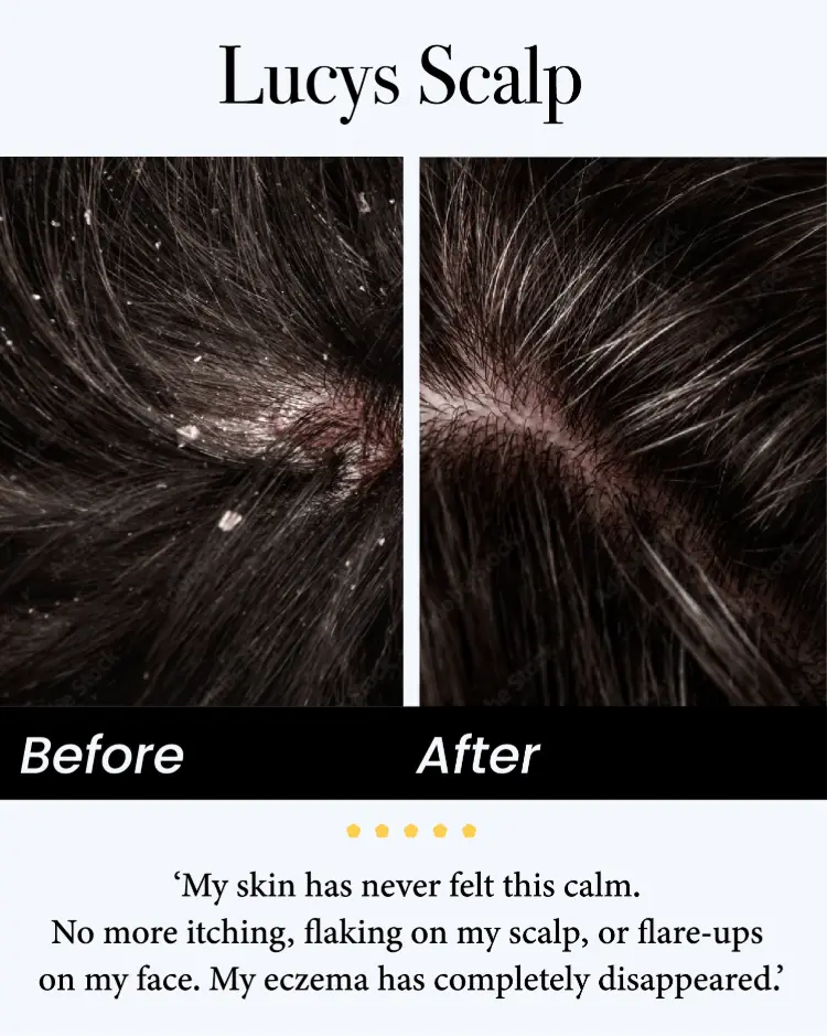 Seborrheic Dermatitis Relief Derm Serum - Image 8