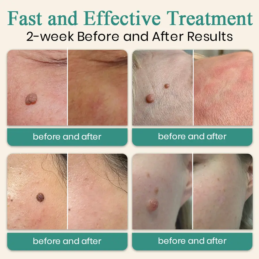 LumeSkin Mole and Wart Instant Removal Laser Pen ACE 6 - Image 2