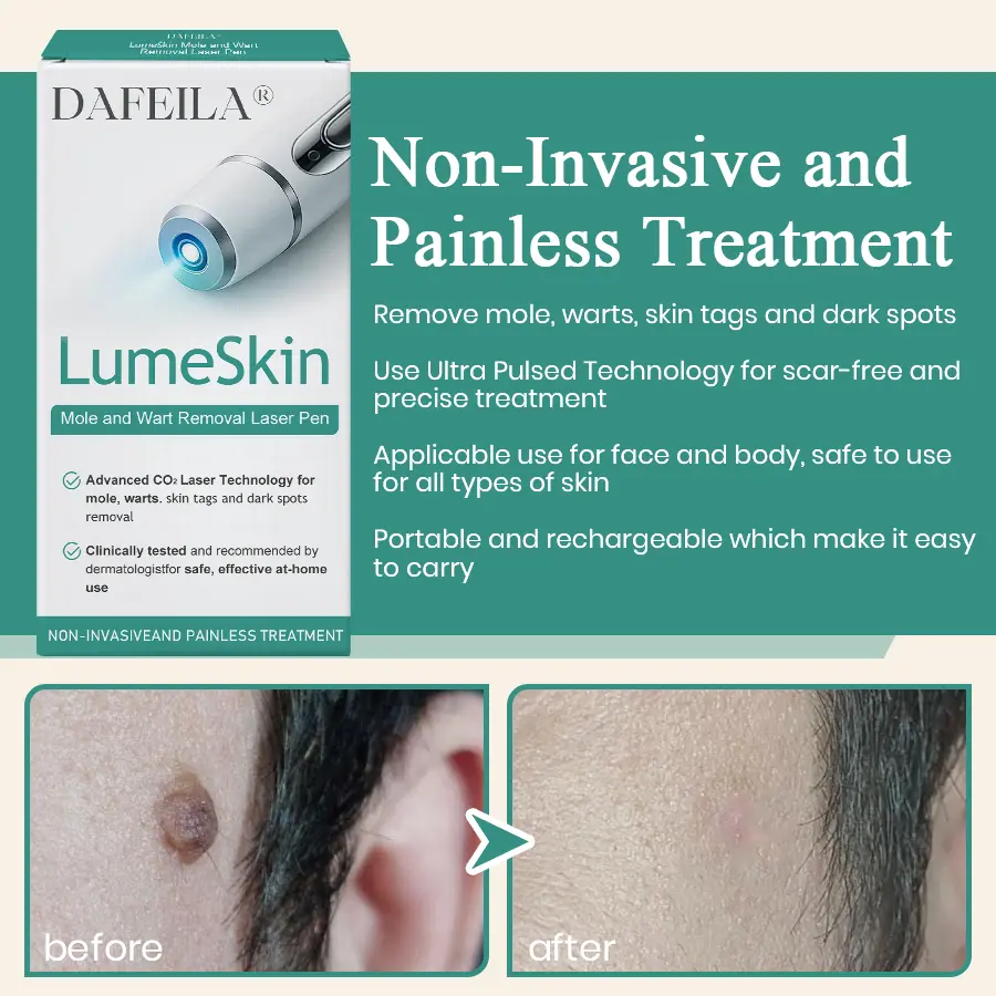LumeSkin Mole and Wart Instant Removal Laser Pen ACE 6 - Image 4