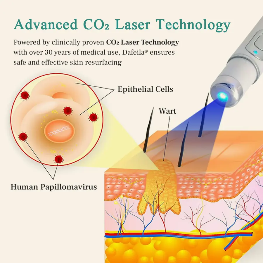 LumeSkin Mole and Wart Instant Removal Laser Pen ACE 6 - Image 5