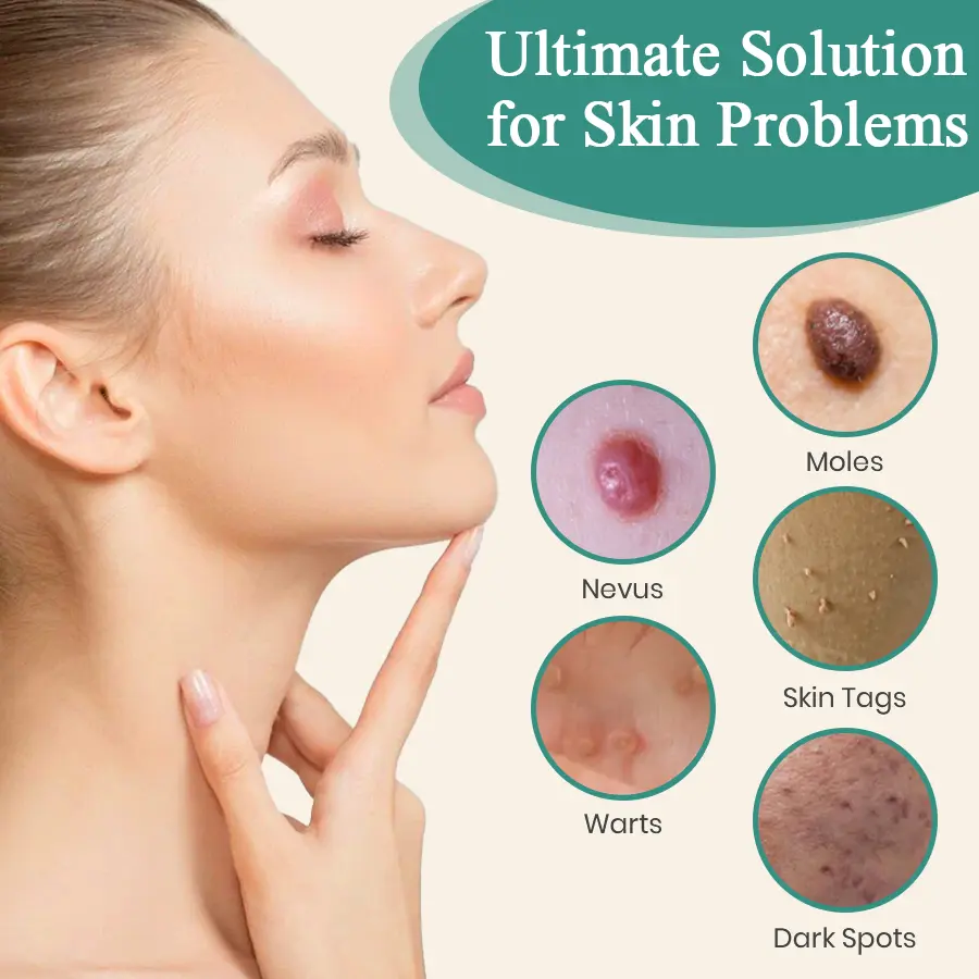 LumeSkin Mole and Wart Instant Removal Laser Pen ACE 6 - Image 8