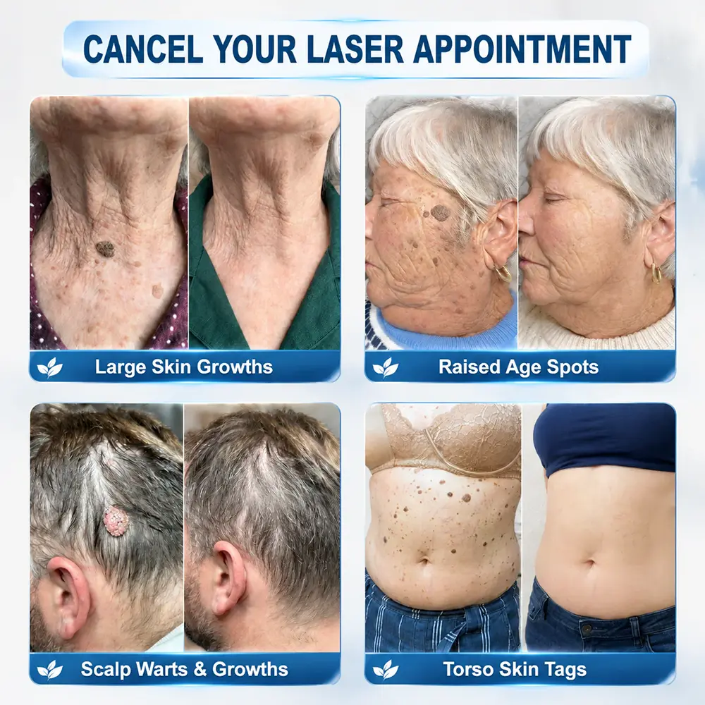 ๐-๐๐๐ ๐๐ธ๐ข๐ง ๐๐๐ด & ๐๐ฉ๐ค๐ญ ๐๐ซ๐๐ฌ๐๐ซ Painless & Scar-Free Advanced Imperfection Remova๐ Ro๐๐erba๐๐ Pen - Image 2