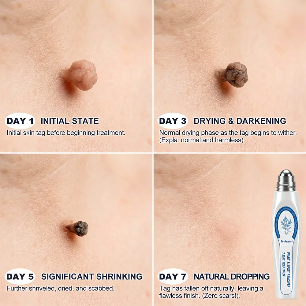 ๐-๐๐๐ ๐๐ธ๐ข๐ง ๐๐๐ด & ๐๐ฉ๐ค๐ญ ๐๐ซ๐๐ฌ๐๐ซ Painless & Scar-Free Advanced Imperfection Remova๐ Ro๐๐erba๐๐ Pen - Image 4