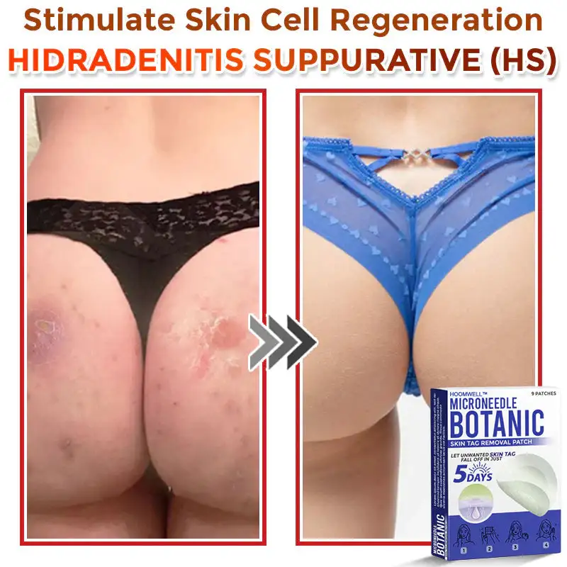 MicroNeedle Botanic Skin Tag Removal Patch - Image 10