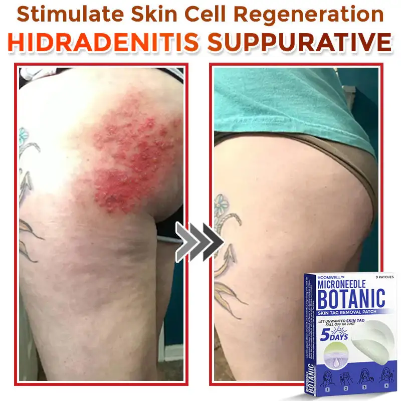 MicroNeedle Botanic Skin Tag Removal Patch - Image 11