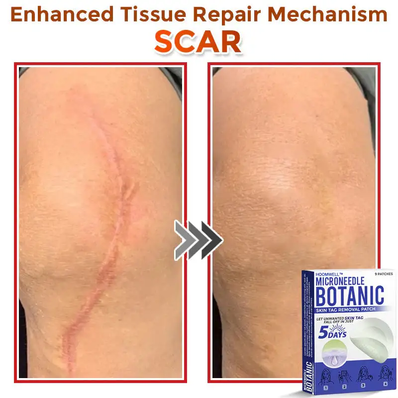 MicroNeedle Botanic Skin Tag Removal Patch - Image 12