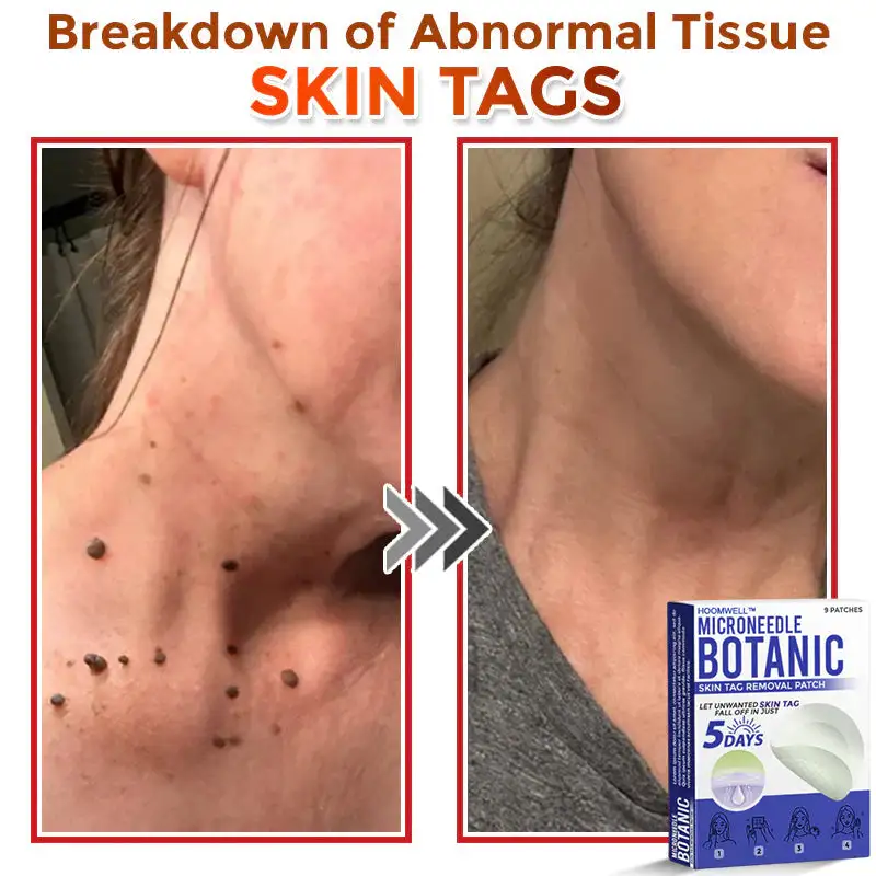 MicroNeedle Botanic Skin Tag Removal Patch - Image 5