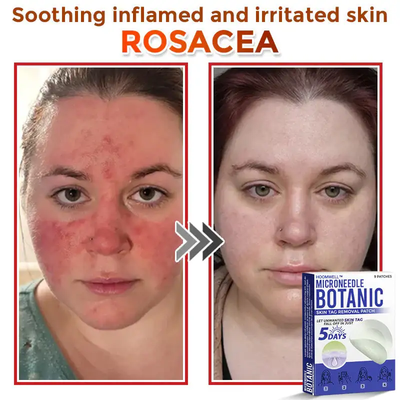 MicroNeedle Botanic Skin Tag Removal Patch - Image 6
