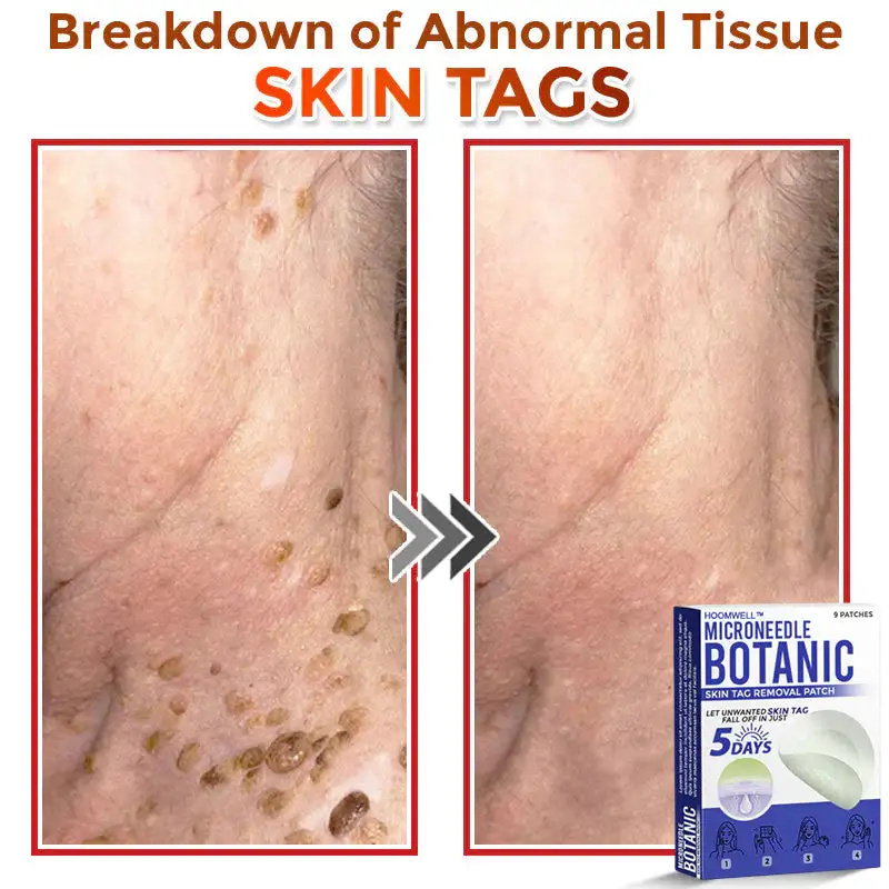 MicroNeedle Botanic Skin Tag Removal Patch - Image 7