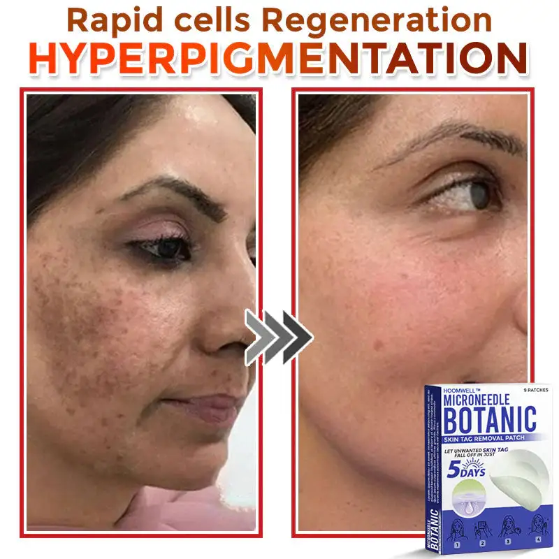 MicroNeedle Botanic Skin Tag Removal Patch - Image 8