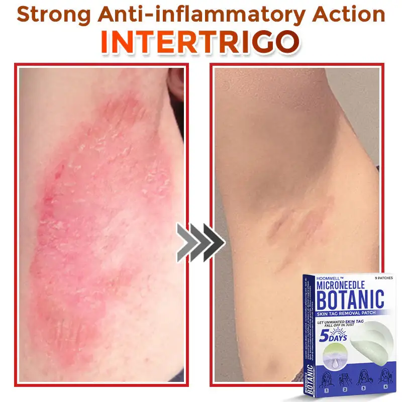 MicroNeedle Botanic Skin Tag Removal Patch - Image 9