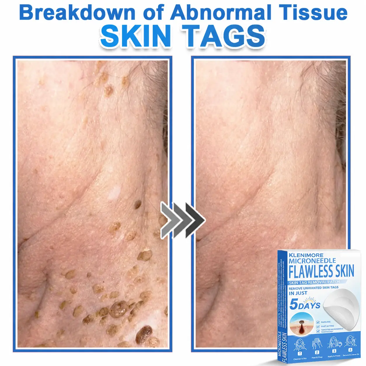 2-in-1 Hydrocolloid Pimple Patches - Image 10