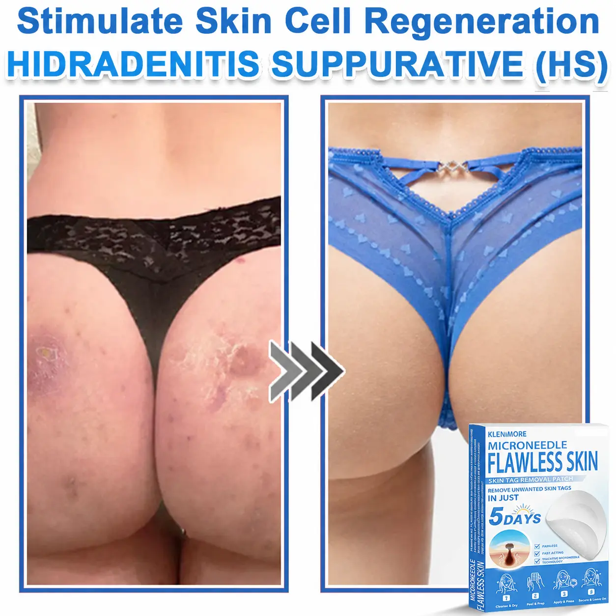 2-in-1 Hydrocolloid Pimple Patches - Image 3