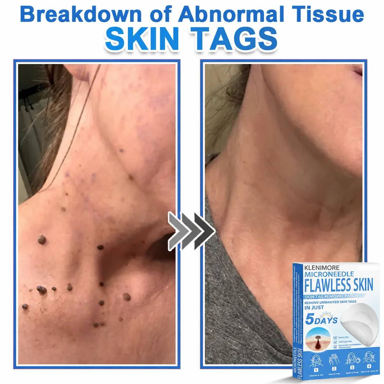 2-in-1 Hydrocolloid Pimple Patches - Image 4