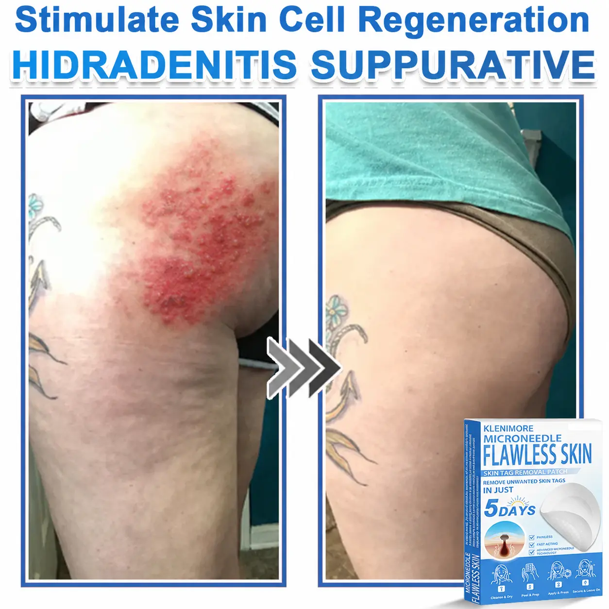 2-in-1 Hydrocolloid Pimple Patches - Image 8