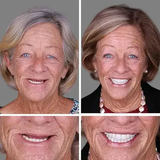 Custom-Fit Smile Support Kit — Strong Suction Feel & Natural-Looking Fit - Image 9