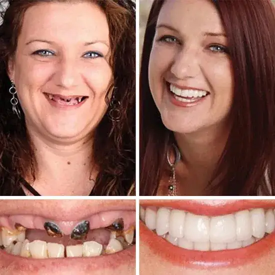 Custom-Fit Smile Support Kit — Strong Suction Feel & Natural-Looking Fit - Image 10
