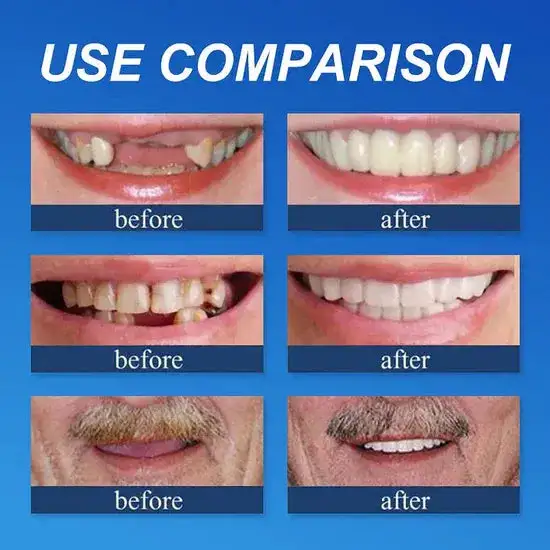 Custom-Fit Smile Support Kit — Strong Suction Feel & Natural-Looking Fit - Image 4