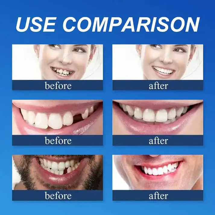Custom-Fit Smile Support Set - Image 10